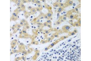 Immunohistochemistry of paraffin-embedded Human liver cancer using SHBG Polyclonal Antibody at dilution of 1:100 (40x lens). (SHBG anticorps)