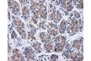 Immunohistochemical staining of paraffin-embedded Carcinoma of liver tissue using anti-BTK mouse monoclonal antibody. (BTK anticorps)