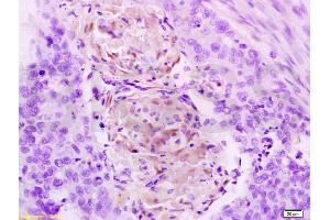 Formalin-fixed and paraffin embedded human esophageal carcinoma tissue labeled with Anti-Cathepsin B Polyclonal Antibody, Unconjugated (ABIN687412) at 1:200 followed by conjugation to the secondary antibody, (SP-0023), and DAB staining