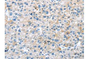 The image on the left is immunohistochemistry of paraffin-embedded Human liver cancer tissue using ABIN7192908(TRIM47 Antibody) at dilution 1/20, on the right is treated with synthetic peptide. (TRIM47 anticorps)