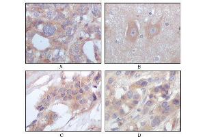 Immunohistochemical analysis of paraffin-embedded human ovary carcinoma (A), normal cerebrum tissues (B), breast infiltrating carcinoma (C) and breast infiltrating carcinoma (D), showing cytoplasmic localization using STYK1/NOK mouse mAb with DAB staining.