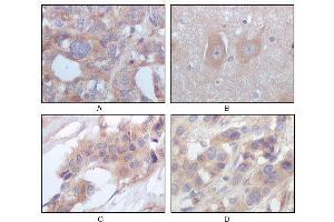 Immunohistochemical analysis of paraffin-embedded human ovary carcinoma (A), normal cerebrum tissues (B), breast infiltrating carcinoma (C) and breast infiltrating carcinoma (D), showing cytoplasmic localization using STYK1/NOK mouse mAb with DAB staining. (STYK1 anticorps)