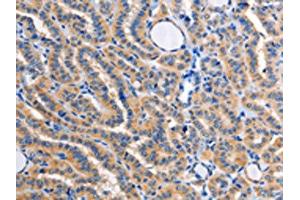 The image on the left is immunohistochemistry of paraffin-embedded Human thyroid cancer tissue using ABIN7128359(ALG8 Antibody) at dilution 1/30, on the right is treated with fusion protein. (ALG8 anticorps)