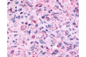 Anti-MTNR1B / MT2 antibody IHC of human Brain, Glioblastoma. (Melatonin Receptor 1B anticorps  (Extracellular Domain))