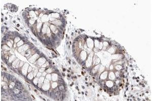 ABIN6266552 at 1/100 staining human Colorectal carcinoma tissue sections by IHC-P. (GRM8 anticorps  (C-Term))