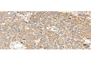 Immunohistochemistry of paraffin-embedded Human liver cancer tissue using C1orf101 Polyclonal Antibody at dilution of 1:65(x200) (C1orf101 anticorps)