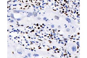 Immunohistochemistry analysis of paraffin-embedded human lymphoma using ERK 2 Polyclonal Antibody at dilution of 1:100. (ERK2 anticorps)
