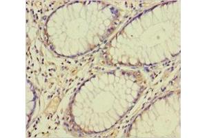 Immunohistochemistry of paraffin-embedded human colon cancer using ABIN7172672 at dilution of 1:100 (TAF12 anticorps  (AA 1-161))