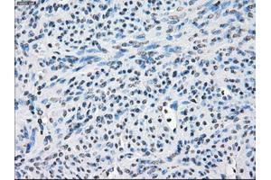 Immunohistochemical staining of paraffin-embedded Adenocarcinoma of colon tissue using anti-FOSL1mouse monoclonal antibody. (FOSL1 anticorps)