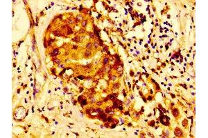 Immunohistochemistry of paraffin-embedded human breast cancer using ABIN7147000 at dilution of 1:100