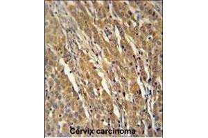 PDXD1 Antibody (C-term) (ABIN651141 and ABIN2840095) immunohistochemistry analysis in formalin fixed and paraffin embedded human cervix carcinoma followed by peroxidase conjugation of the secondary antibody and DAB staining. (PDXDC1 anticorps  (C-Term))