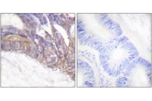 Immunohistochemistry analysis of paraffin-embedded human colon carcinoma, using LAT (Phospho-Tyr191) Antibody. (LAT anticorps  (pTyr191))