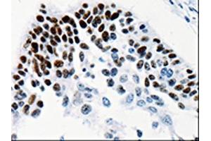 The image on the left is immunohistochemistry of paraffin-embedded Human cervical cancer tissue using ABIN7131338(TGIF2LX Antibody) at dilution 1/25, on the right is treated with fusion protein. (TGIF2LX anticorps)