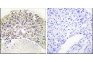 Immunohistochemistry analysis of paraffin-embedded human breast carcinoma, using Shc (Phospho-Tyr349) Antibody. (SHC1 anticorps  (pTyr349))