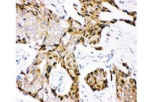 IHC-P: Ubiquitin antibody testing of human mammary cancer tissue (Ubiquitin anticorps  (AA 77-152))