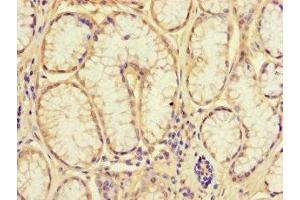 Immunohistochemistry of paraffin-embedded human gastric cancer using ABIN7161926 at dilution of 1:100 (NRIP3 anticorps  (AA 1-241))