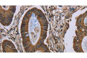 Immunohistochemistry of paraffin-embedded Human colon cancer tissue using NEFH Polyclonal Antibody at dilution 1:40 (NEFH anticorps)