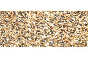 Immunohistochemistry of paraffin-embedded Human prostate cancer tissue using SLC6A19 Polyclonal Antibody at dilution 1:35