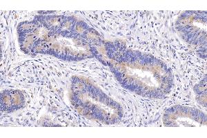 Detection of Bcl2 in Human Colorectal cancer Tissue using Monoclonal Antibody to B-Cell Leukemia/Lymphoma 2 (Bcl2)
