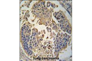 Formalin-fixed and paraffin-embedded human lung carcinoma tissue reacted with RIP3 (RIPK3) antibody , which was peroxidase-conjugated to the secondary antibody, followed by DAB staining. (RIPK3 anticorps  (C-Term))