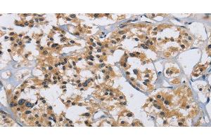Immunohistochemistry of paraffin-embedded Human thyroid cancer tissue using IL12RB2 Polyclonal Antibody at dilution 1:40 (IL12RB2 anticorps)