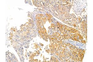 ABIN6260480 and ABIN6266502 at 1/100 staining Human liver cancer by IHC-P. (Caspase 10 anticorps)