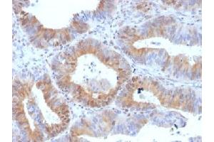 IHC testing of FFPE human ovarian carcinoma with LHR antibody (clone LHCGR/1417). (LHCGR anticorps  (N-Term))