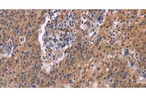 Immunohistochemistry of paraffin-embedded Human liver cancer tissue using HSD11B2 Polyclonal Antibody at dilution 1:35 (HSD11B2 anticorps)