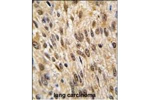 Formalin-fixed and paraffin-embedded human lung carcinoma tissue reacted with PTPN6 antibody (Center), which was peroxidase-conjugated to the secondary antibody, followed by DAB staining. (SHP1 anticorps  (AA 247-277))