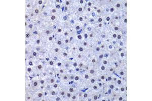 Immunohistochemistry of paraffin-embedded human liver cancer using GSTP1 antibody (ABIN5973328) at dilution of 1/200 (40x lens). (GSTP1 anticorps)