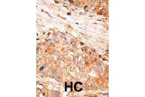 Formalin-fixed and paraffin-embedded human hepatocellular carcinoma tissue reacted with BIRC7 polyclonal antibody  , which was peroxidase-conjugated to the secondary antibody, followed by AEC staining. (BIRC7 anticorps  (C-Term))
