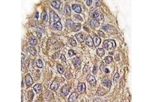 IHC analysis of FFPE human lung carcinoma tissue stained with Aldolase antibody