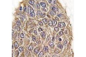 IHC analysis of FFPE human lung carcinoma tissue stained with Aldolase antibody (ALDOA anticorps  (AA 66-95))