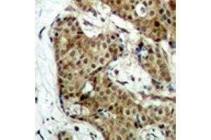 Immunohistochemical analysis of GAPDH staining in human breast cancer formalin fixed paraffin embedded tissue section. (GAPDH anticorps)