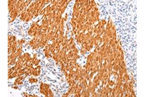 The image on the left is immunohistochemistry of paraffin-embedded Human gastric cancer tissue using ABIN7190022(BSN Antibody) at dilution 1/20, on the right is treated with synthetic peptide. (Bassoon anticorps)