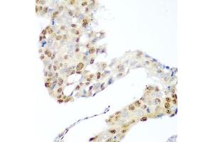 Immunohistochemistry of paraffin-embedded human lung cancer using CDK1 antibody.