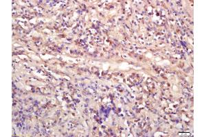 Formalin-fixed and paraffin embedded human lung carcinoma labeled with Anti-WNT9A Polyclonal Antibody, Unconjugated (ABIN675533) at 1:200 followed by conjugation to the secondary antibody and DAB staining (WNT9A anticorps  (AA 21-120))