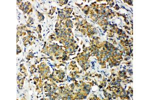 Anti-PDK2 antibody, IHC(P) IHC(P): Human Mammary Cancer Tissue