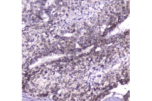 IHC testing of FFPE human liver cancer tissue with CLPP antibody at 1ug/ml. (CLPP anticorps)