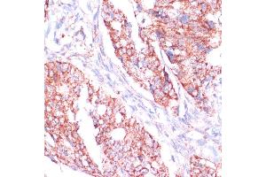 Immunohistochemistry of paraffin-embedded human colon carcinoma using RPL24 antibody (ABIN7269998) at dilution of 1:100 (40x lens).