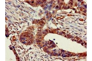 Immunohistochemistry of paraffin-embedded human colon cancer using ABIN7142959 at dilution of 1:100 (CHRNB1 anticorps  (AA 24-244))