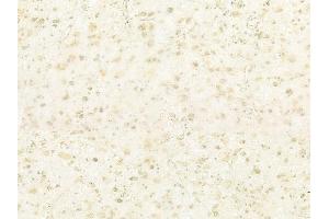 ABIN6260727 and ABIN6278679 at 1/100 staining human astrocytoma by IHC-P. (CDKL5 anticorps  (Internal Region))