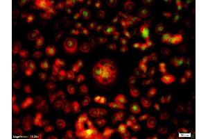 Formalin-fixed and paraffin embedded human oral squamous cell carcinoma labeled with Rabbit Anti-Survivin Polyclonal Antibody, Unconjugated  at 1:200 followed by Goat Anti-Rabbit IgG, FITC conjugated -FITC) used at 1:300 dilution for 40 minutes at 37°C.