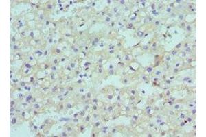 Immunohistochemistry of paraffin-embedded human liver cancer using ABIN7147709 at dilution of 1:100