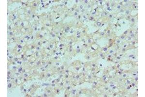 Immunohistochemistry of paraffin-embedded human liver cancer using ABIN7147709 at dilution of 1:100 (CBX8 anticorps  (AA 80-280))