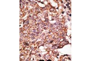 Formalin-fixed and paraffin-embedded human cancer tissue reacted with the primary antibody, which was peroxidase-conjugated to the secondary antibody, followed by AEC staining.