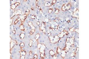 Immunohistochemistry of paraffin-embedded Human liver cancer using CD36 Polyclonal Antibody at dilution of 1:200 (40x lens). (CD36 anticorps)