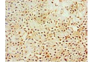 Immunohistochemistry of paraffin-embedded human breast cancer using ABIN7161640 at dilution of 1:100 (KLRC1 anticorps  (AA 114-233))