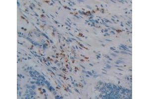 IHC-P analysis of Human Rectum Cancer Tissue, with DAB staining. (PTPRQ anticorps  (AA 36-294))