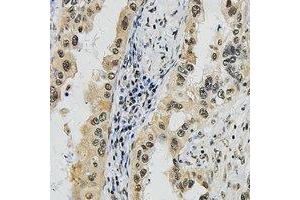 Immunohistochemical analysis of SUPT16H staining in human lung cancer formalin fixed paraffin embedded tissue section. (SUPT16H anticorps  (C-Term))